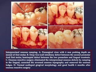 Interproximal osseous ramping. A. Presurgical view with 6 mm probing depth on
mesial of first molar. B. Deep two-wall intrabony defect between the second premolar
And first molar, hemiseptal defect between the two premolars and lingual exostosis.
C. Osseous resective surgery eliminated the interproximal osseous defects by ramping
to the lingual, corrected the reversed osseous topography and removed the osseous
ledges. D. Normal scalloped gingival morphology and good health 6 months after
osseous resective surgery
 