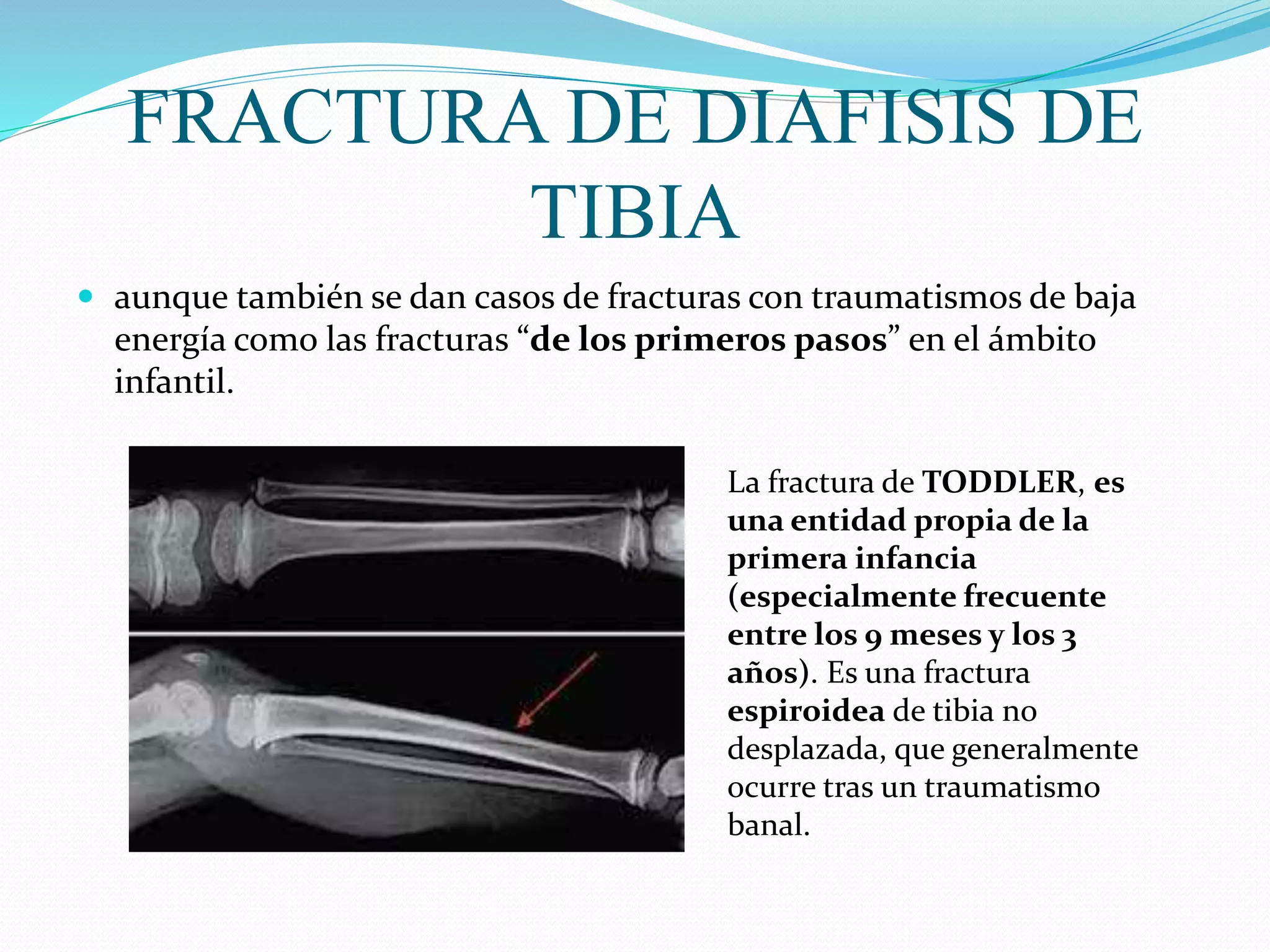 7. FX DE DIAFISIS DE TIBIA Y FX DE PILON TIBIAL.pptx