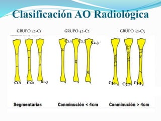 7. FX DE DIAFISIS DE TIBIA Y FX DE PILON TIBIAL.pptx