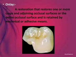 • Onlay:-
A restoration that restores one or more
cusps and adjoining occlusal surfaces or the
entire occlusal surface and is retained by
mechnical or adhesive means.
 