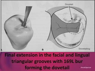 Final extension in the facial and lingual
triangular grooves with 169L bur
forming the dovetail
 