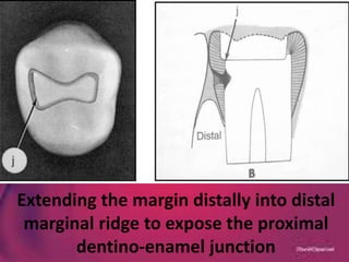 Extending the margin distally into distal
marginal ridge to expose the proximal
dentino-enamel junction
 