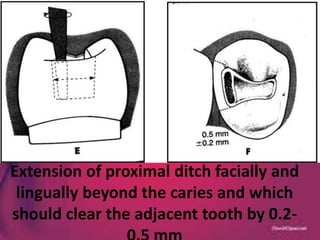 Extension of proximal ditch facially and
lingually beyond the caries and which
should clear the adjacent tooth by 0.2-
 