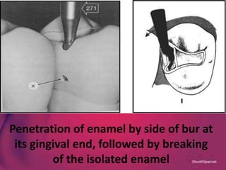 Penetration of enamel by side of bur at
its gingival end, followed by breaking
of the isolated enamel
 