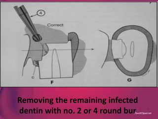 Removing the remaining infected
dentin with no. 2 or 4 round bur
 
