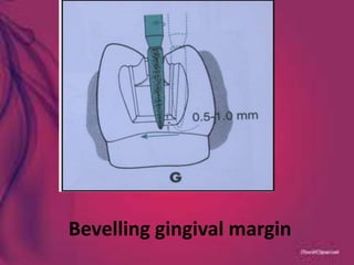 Bevelling gingival margin
 