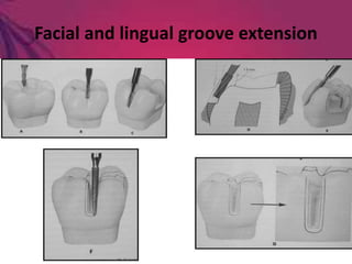 Facial and lingual groove extension
 