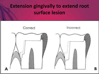 Extension gingivally to extend root
surface lesion
 