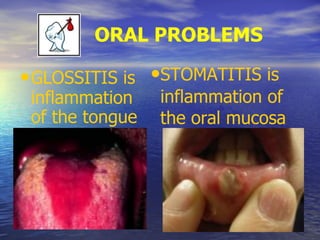 ORAL PROBLEMS
•GLOSSITIS is
inflammation
of the tongue
•STOMATITIS is
inflammation of
the oral mucosa
 