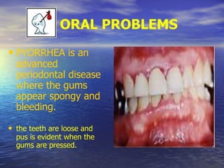 ORAL PROBLEMS
• PYORRHEA is an
advanced
periodontal disease
where the gums
appear spongy and
bleeding.
• the teeth are loose and
pus is evident when the
gums are pressed.
 