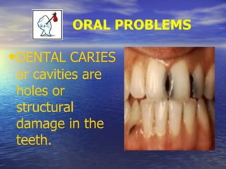 ORAL PROBLEMS
•DENTAL CARIES
or cavities are
holes or
structural
damage in the
teeth.
 