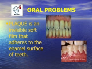 ORAL PROBLEMS
•PLAQUE is an
invisible soft
film that
adheres to the
enamel surface
of teeth.
 