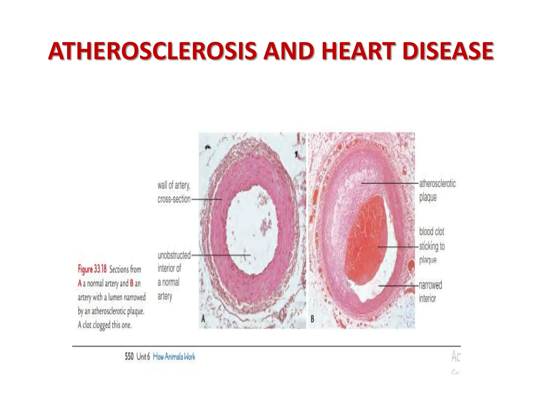 ATHEROSCLEROSIS AND HEART DISEASE
 