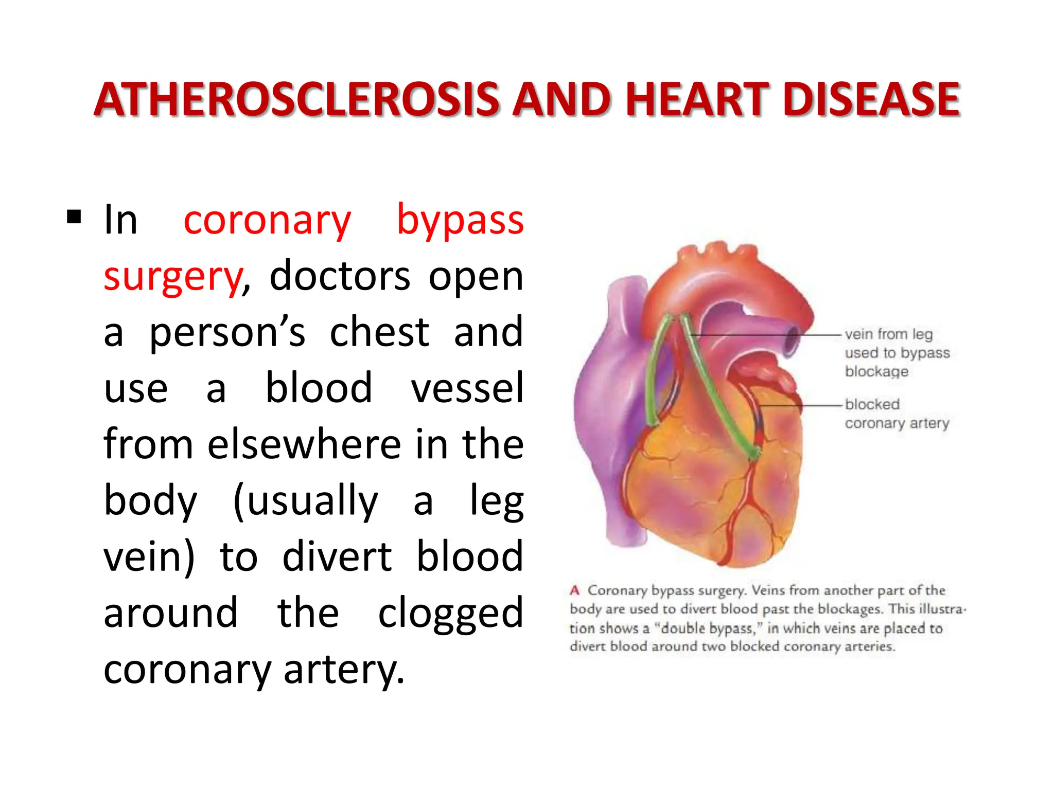 ATHEROSCLEROSIS AND HEART DISEASE
 In coronary bypass
surgery, doctors open
a person’s chest and
use a blood vessel
from elsewhere in the
body (usually a leg
vein) to divert blood
around the clogged
coronary artery.
 