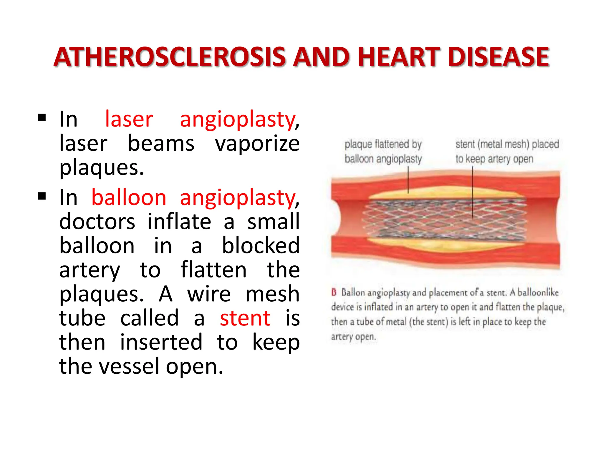 ATHEROSCLEROSIS AND HEART DISEASE
 In laser angioplasty,
laser beams vaporize
plaques.
 In balloon angioplasty,
doctors inflate a small
balloon in a blocked
artery to flatten the
plaques. A wire mesh
tube called a stent is
then inserted to keep
the vessel open.
 
