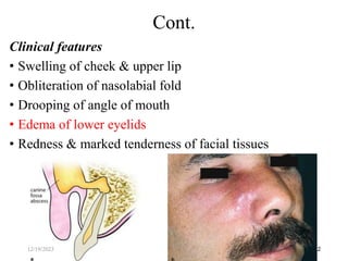 Clinical features
• Swelling of cheek & upper lip
• Obliteration of nasolabial fold
• Drooping of angle of mouth
• Edema of lower eyelids
• Redness & marked tenderness of facial tissues
32
Cont.
12/19/2023
 