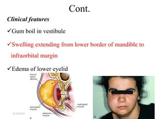 Clinical features
Gum boil in vestibule
Swelling extending from lower border of mandible to
infraorbital margin
Edema of lower eyelid
36
Cont.
12/19/2023
 