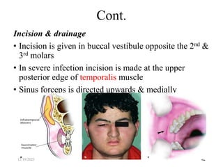 Incision & drainage
• Incision is given in buccal vestibule opposite the 2nd &
3rd molars
• In severe infection incision is made at the upper
posterior edge of temporalis muscle
• Sinus forceps is directed upwards & medially
42
Cont.
12/19/2023
 
