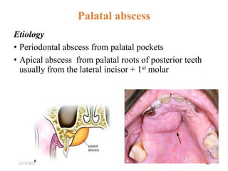 Etiology
• Periodontal abscess from palatal pockets
• Apical abscess from palatal roots of posterior teeth
usually from the lateral incisor + 1st molar
43
Palatal abscess
12/19/2023
 