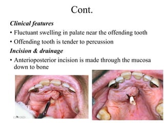 Clinical features
• Fluctuant swelling in palate near the offending tooth
• Offending tooth is tender to percussion
Incision & drainage
• Anterioposterior incision is made through the mucosa
down to bone
44
Cont.
12/19/2023
 