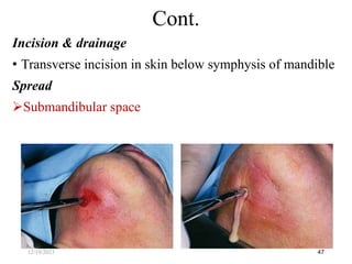 Incision & drainage
• Transverse incision in skin below symphysis of mandible
Spread
Submandibular space
47
Cont.
12/19/2023
 