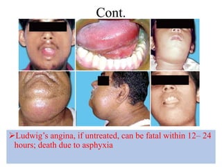 Cont.
82
12/19/2023
Ludwig’s angina, if untreated, can be fatal within 12– 24
hours; death due to asphyxia
 