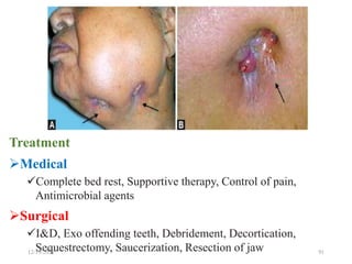 Cont.
Treatment
Medical
Complete bed rest, Supportive therapy, Control of pain,
Antimicrobial agents
Surgical
I&D, Exo offending teeth, Debridement, Decortication,
Sequestrectomy, Saucerization, Resection of jaw
12/19/2023 91
 