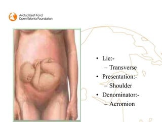 • Lie:-
– Transverse
• Presentation:-
– Shoulder
• Denominator:-
– Acromion
 