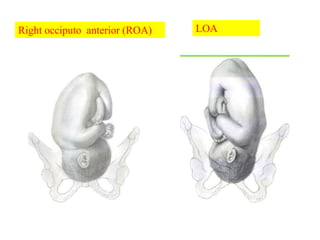 LOA
Right occiputo anterior (ROA)
 