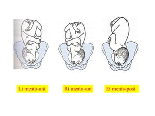 Lt mento-ant Rt mento-ant Rt mento-post
 