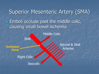 Superior Mesenteric Artery (SMA)
 Emboli occlude past the middle colic,
causing small bowel ischemia
SMA
Middle Colic
Right Colic
Ileocolic
Jejunal & Ileal
Arteries
Occlusion
Point
 