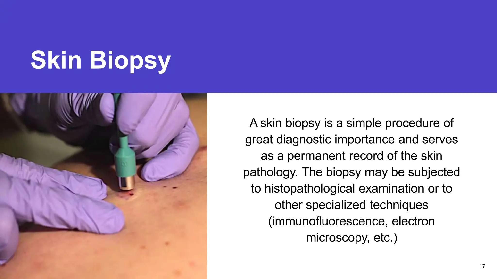 Skin Biopsy
Presentation title
A skin biopsy is a simple procedure of
great diagnostic importance and serves
as a permanent record of the skin
pathology. The biopsy may be subjected
to histopathological examination or to
other specialized techniques
(immunofluorescence, electron
microscopy, etc.)
17
 