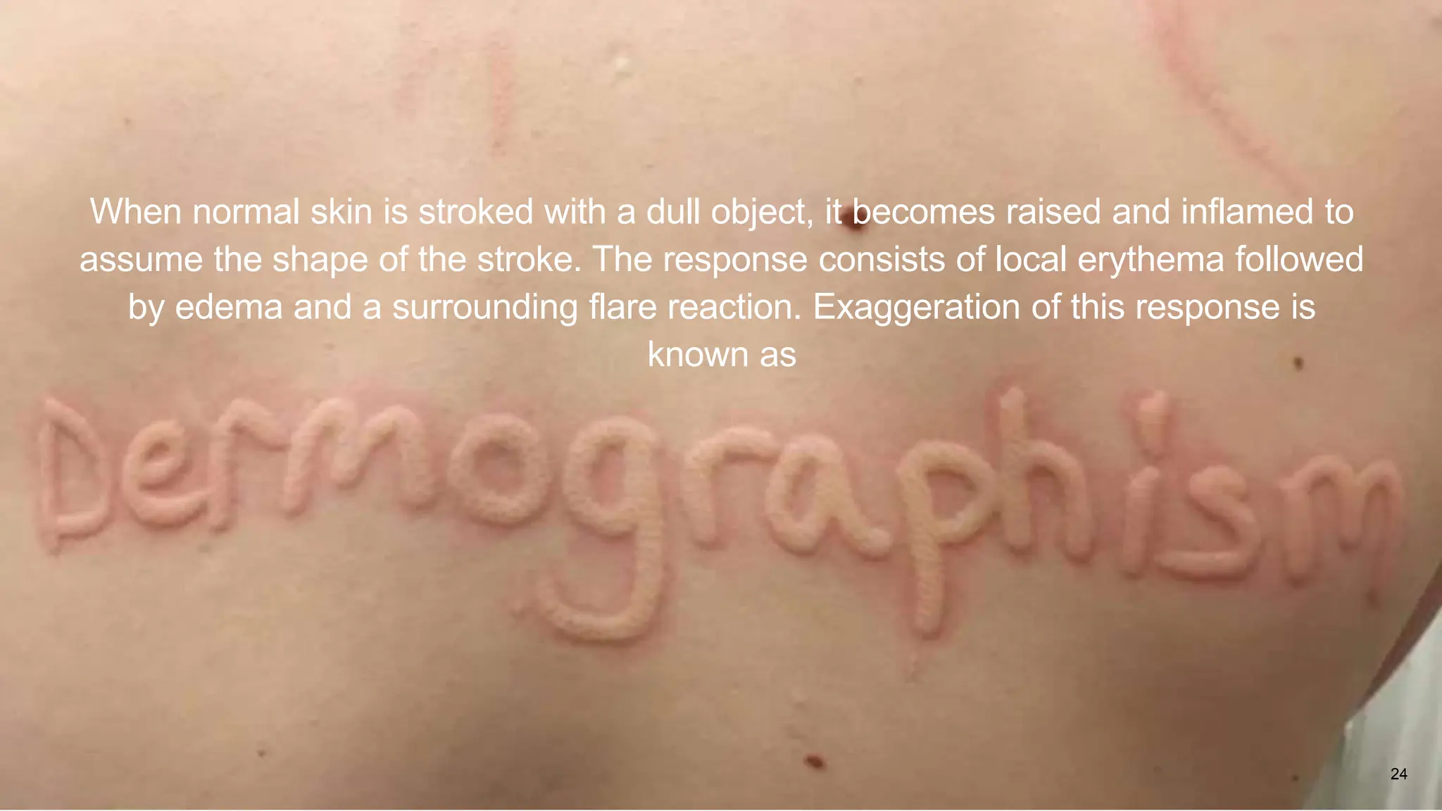 24
When normal skin is stroked with a dull object, it becomes raised and inflamed to
assume the shape of the stroke. The response consists of local erythema followed
by edema and a surrounding flare reaction. Exaggeration of this response is
known as
 