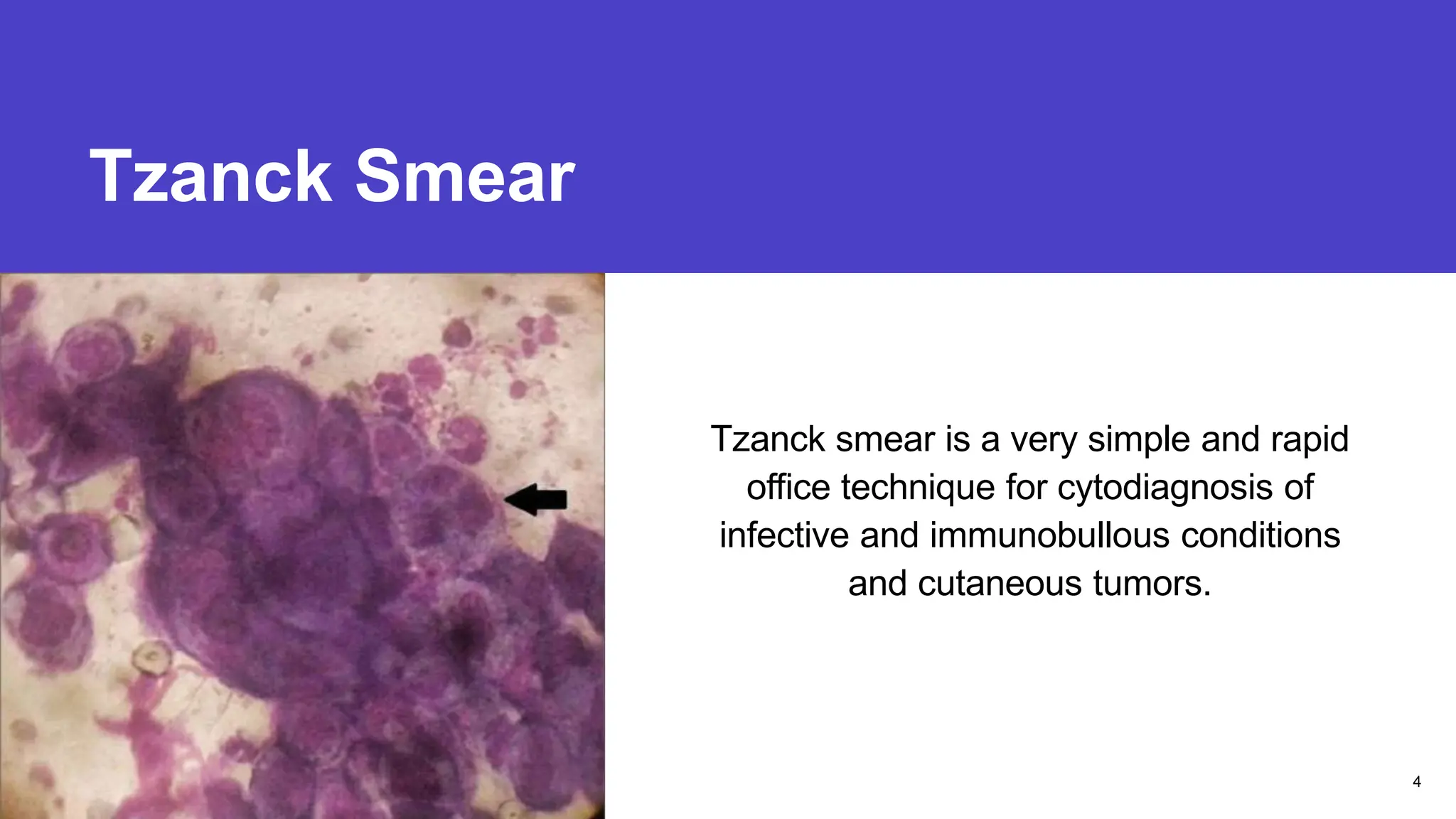 Tzanck Smear
Presentation title
Tzanck smear is a very simple and rapid
office technique for cytodiagnosis of
infective and immunobullous conditions
and cutaneous tumors.
4
 