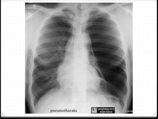 pneumothoraks
 