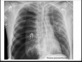 Tension pneumothoraks
 