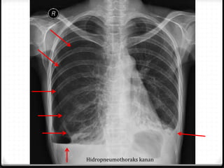 Hidropneumothoraks kanan
 