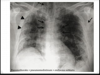 Pneumothoraks + pneumomedistinum + emfisema subkutis
 