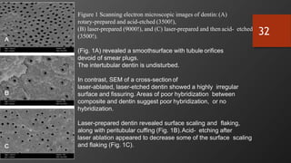 Figure 1 Scanning electron microscopic images of dentin:(A)
rotary-prepared and acid-etched (3500!),
(B) laser-prepared (9000!), and (C) laser-prepared and then acid- etched
(3500!).
(Fig. 1A) revealed a smoothsurface with tubule orifices
devoid of smear plugs.
The intertubular dentin is undisturbed.
In contrast, SEM of a cross-section of
laser-ablated, laser-etched dentin showed a highly irregular
surface and fissuring. Areas of poor hybridization between
composite and dentin suggest poor hybridization, or no
hybridization.
Laser-prepared dentin revealed surface scaling and flaking,
along with peritubular cuffing (Fig. 1B).Acid- etching after
laser ablation appeared to decrease some of the surface scaling
and flaking (Fig. 1C).
32
 
