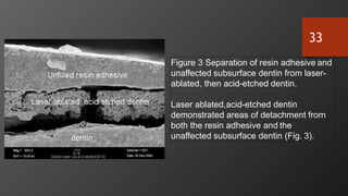 Figure 3 Separation of resin adhesive and
unaffected subsurface dentin from laser-
ablated, then acid-etched dentin.
Laser ablated,acid-etched dentin
demonstrated areas of detachment from
both the resin adhesive and the
unaffected subsurface dentin (Fig. 3).
33
 