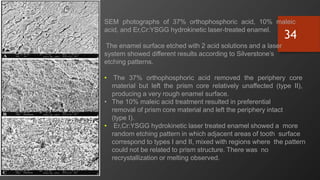 SEM photographs of 37% orthophosphoric acid, 10% maleic
acid, and Er,Cr:YSGG hydrokinetic laser-treated enamel.
The enamel surface etched with 2 acid solutions and a laser
system showed different results according to Silverstone’s
etching patterns.
• The 37% orthophosphoric acid removed the periphery core
material but left the prism core relatively unaffected (type II),
producing a very rough enamel surface.
• The 10% maleic acid treatment resulted in preferential
removal of prism core material and left the periphery intact
(type I).
• Er,Cr:YSGG hydrokinetic laser treated enamel showed a more
random etching pattern in which adjacent areas of tooth surface
correspond to types I and II, mixed with regions where the pattern
could not be related to prism structure. There was no
recrystallization or melting observed.
34
 