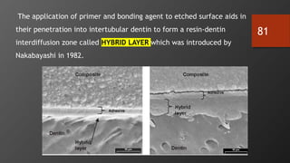 81
The application of primer and bonding agent to etched surface aids in
their penetration into intertubular dentin to form a resin-dentin
interdiffusion zone called HYBRID LAYER which was introduced by
Nakabayashi in 1982.
 