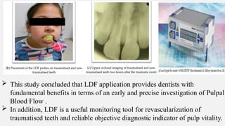  This study concluded that LDF application provides dentists with
fundamental benefits in terms of an early and precise investigation of Pulpal
Blood Flow .
 In addition, LDF is a useful monitoring tool for revascularization of
traumatised teeth and reliable objective diagnostic indicator of pulp vitality.
 