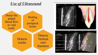 Use of Ultrasound
Healing
of
periapical
lesion
Detect the
pulpal
blood flow
in vital
tooth.
Detects
cracks
Detects
Vertical
root
fractures
 