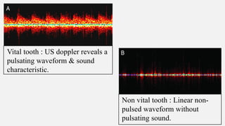 Vital tooth : US doppler reveals a
pulsating waveform & sound
characteristic.
Non vital tooth : Linear non-
pulsed waveform without
pulsating sound.
 