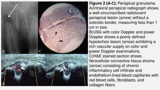 Figure 2 (A-C): Periapical granuloma.
A)Intraoral periapical radiograph shows
a well-circumscribed radiolucent
periapical lesion (arrow) without a
sclerotic border, measuring less than 1
cm in size.
B)USG with color Doppler and power
Doppler shows a poorly defined
hypoechoic lesion (arrow) exhibiting a
rich vascular supply on color and
power Doppler examinations.
C)H&E stained section shows
fibrocellular connective tissue stroma
(arrow) consisting of chronic
inflammatory cell infiltrate and
endothelium-lined blood capillaries with
red blood cells, fibroblasts, and
collagen fibers
 