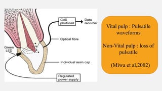 Vital pulp : Pulsatile
waveforms
Non-Vital pulp : loss of
pulsatile
(Miwa et al,2002)
 