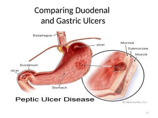 Comparing Duodenal
and Gastric Ulcers
11
 