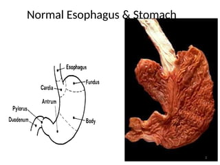 Normal Esophagus & Stomach
3
 