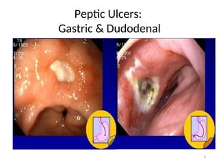 Peptic Ulcers:
Gastric & Dudodenal
6
 
